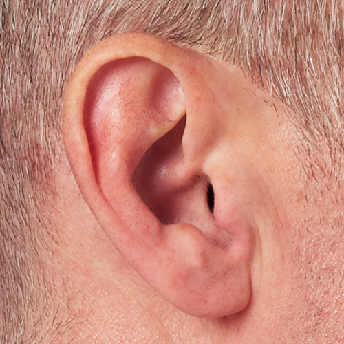 Invisible-In-Canal hearing aid in ear